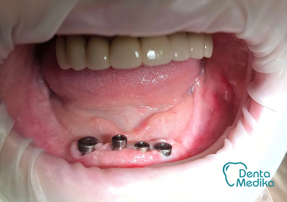 Třmenová hybridní náhrada na implantátech pro bezzubou čelist 1